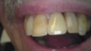 Greally-Stewart-080616-after-crown-treatment-300x169